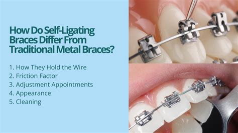 Self Ligating Braces