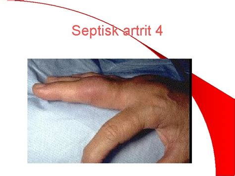 septisk artrit handled