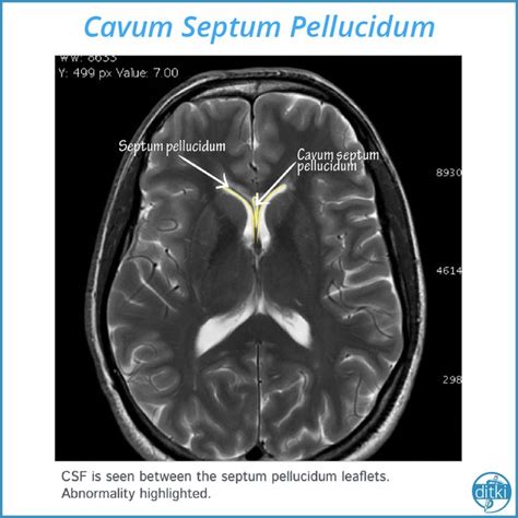 septum pellucidum ct