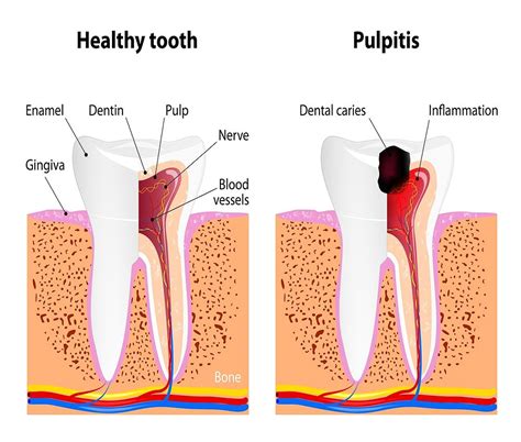 Sequelae Of Pulpitis