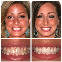 shannon ford teeth veneers - nicoletti-immobilier.com