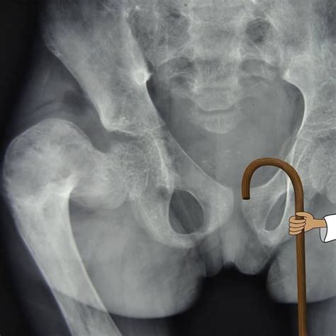 Shepherd Crook Deformity