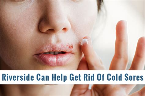 should you date someone who gets cold sores