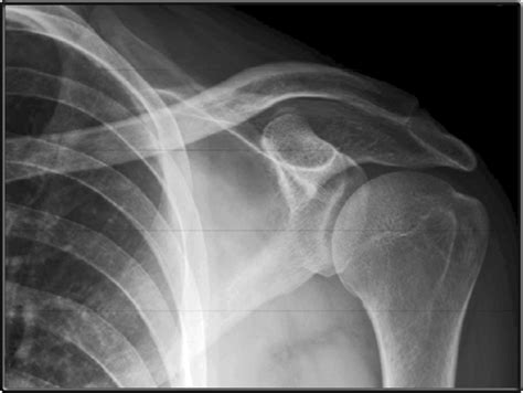 Shoulder Ap View