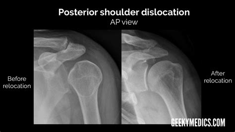 Shoulder Dislocation X Ray