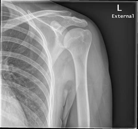 Shoulder X Rays Of Normal Shoulder