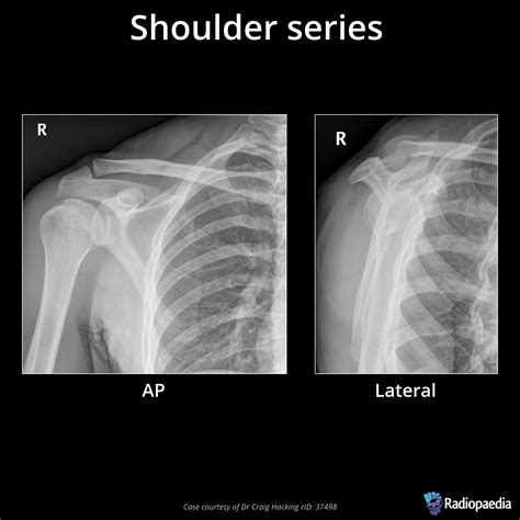 Shoulder Xray 3 View