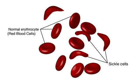 sickle cell anemia بالعربي