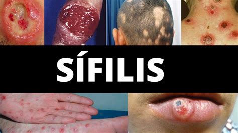 sifilis