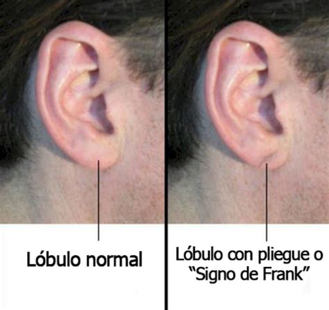 Signo De Frank