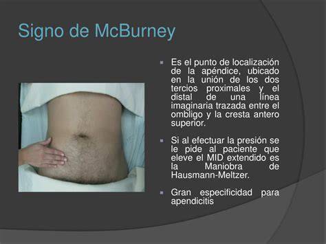 Signo De Mcburney