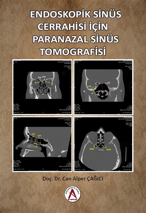 sinüs tomografisi