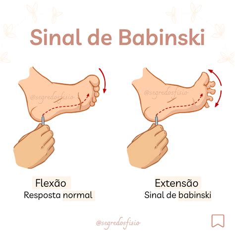 Sinal De Babinski