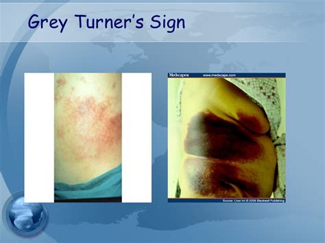Sinal De Grey Turner
