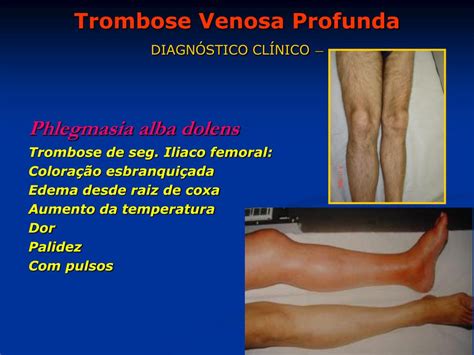 Sinal De Homans