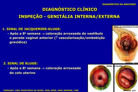 Sinal De Hunter