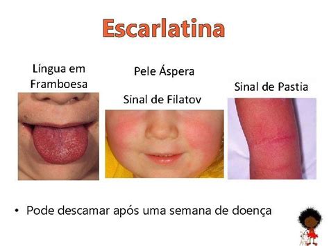 Sinal De Pastia