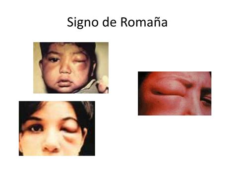 Sinal De Romana