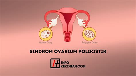 sindrom polikistik ovarium