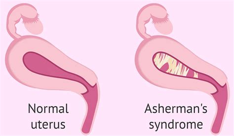 Sindrome De Asherman