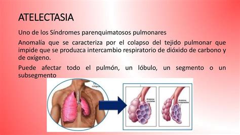 sindrome de atelectasia pulmonar pdf