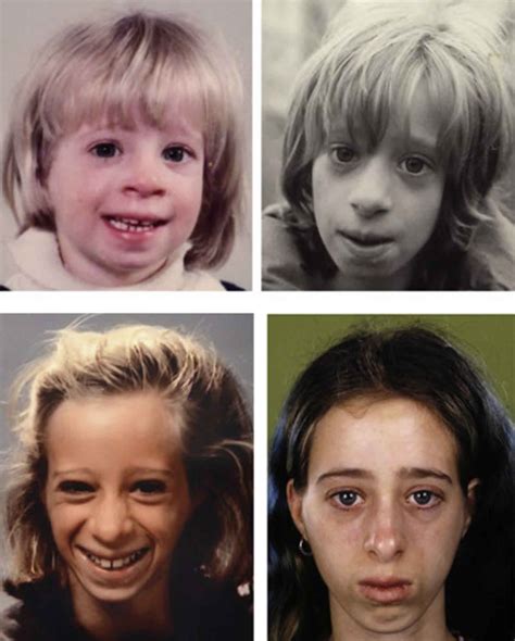Sindrome De Bloom