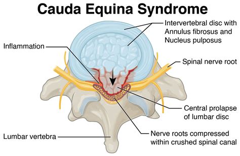 Sindrome De Cauda Equina