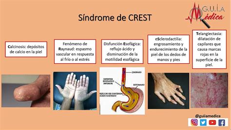 Sindrome De Crest
