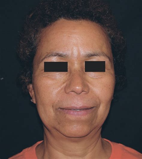 Sindrome De Ekbom