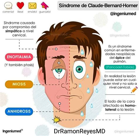 Sindrome De Horner
