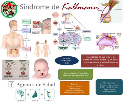 Sindrome De Kallmann
