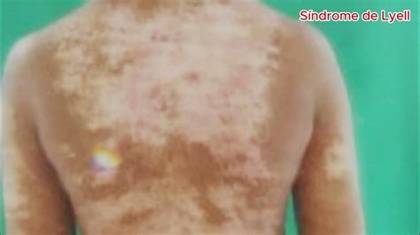 Sindrome De Lyell