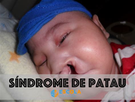 sindrome de patau