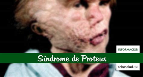Sindrome De Proteus