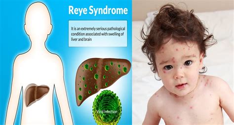Sindrome De Reye