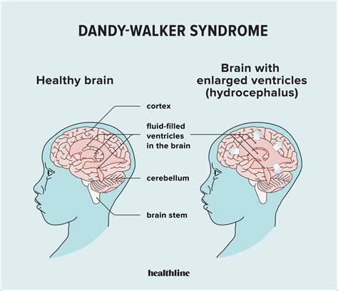 Sindrome De Walker Dandy