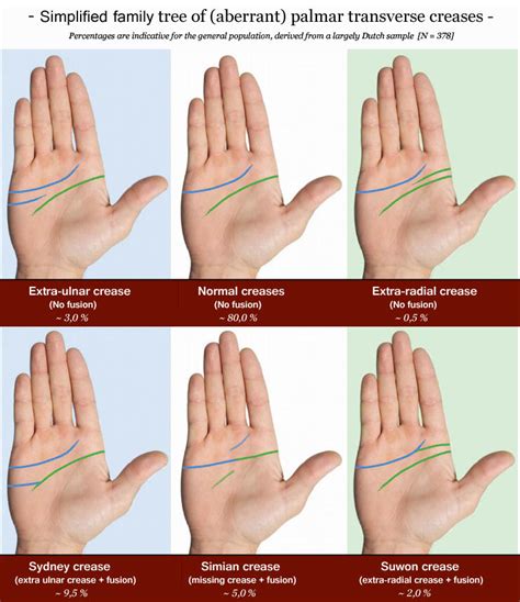 Single Palmar Crease