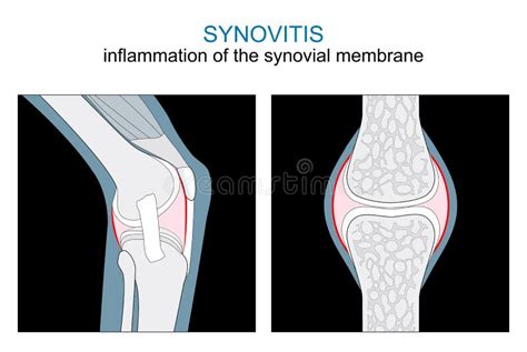 Sinovitis De Rodilla