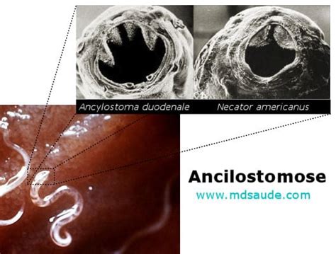Sintomas Do Ancilostomose