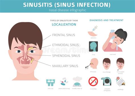 sinusitis behandeling