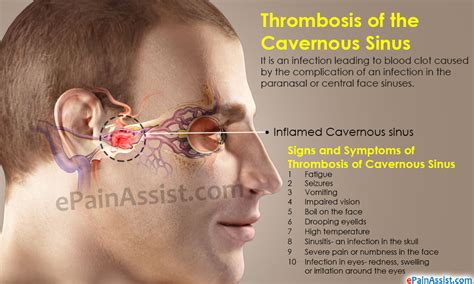 Sinusitis Cavernous Sinus Thrombosis