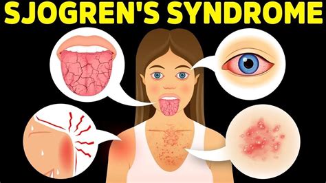 sjögrens symptom