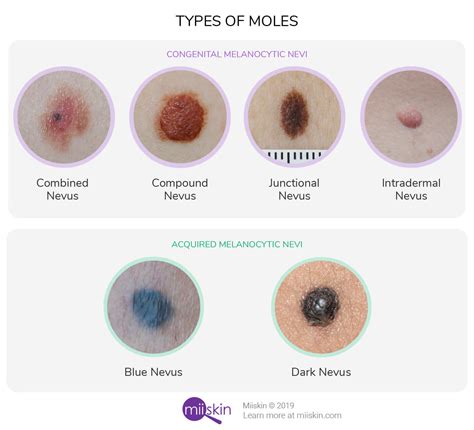 skin colored mole