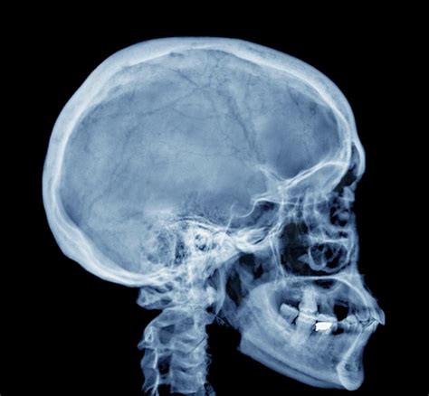 Skull X Ray