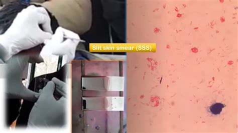 Slit Skin Smear