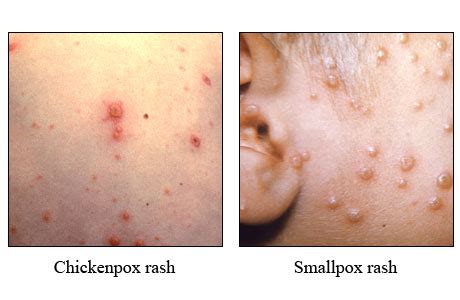 Smallpox Vs Chickenpox