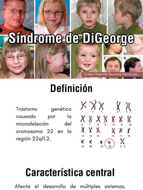 Sme De Digeorge