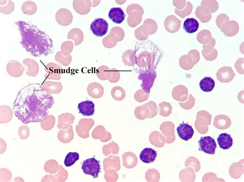 smudge cells - UpToDate