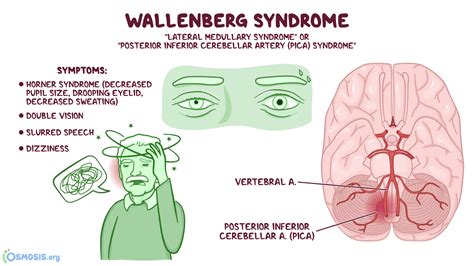 Síndrome De Wallenberg