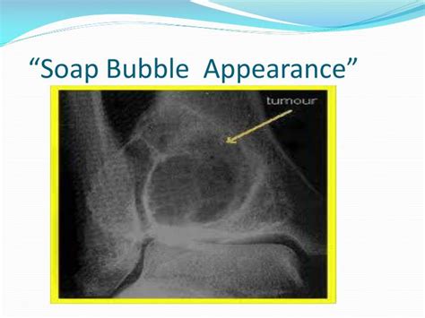 Soap Bubble Appearance